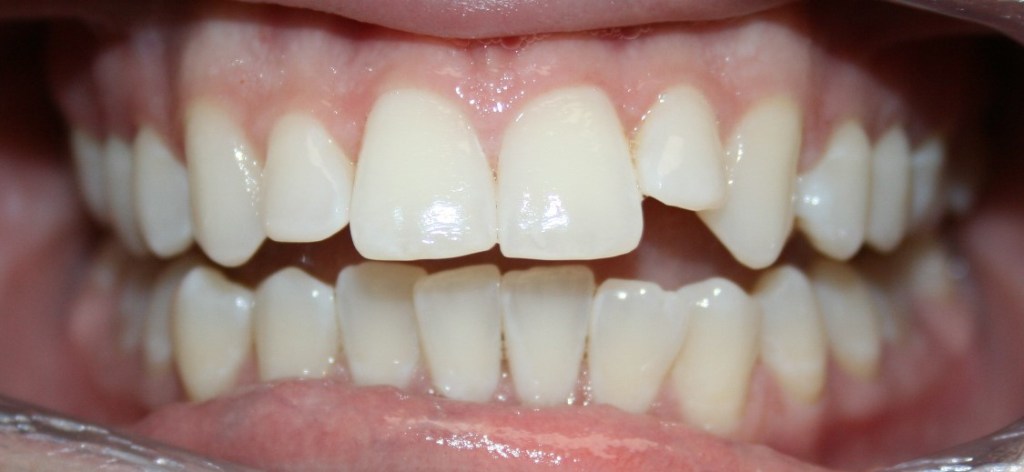 Smile Gallery Walnut Creek  Orthodontic Before and After Photos